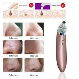 Máquina de Limpeza Facial Acne e Pontos Negro 4 em 1